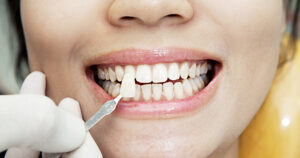 Dentist matching up a porcelain veneer up to patients natural teeth.
