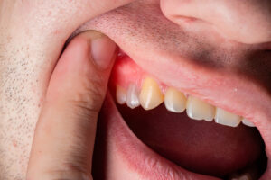 Close-up of a male holding his mouth open, showing his painful gum